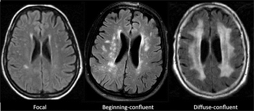 HBOT Treatment For White Matter Lesions in Aurangabad